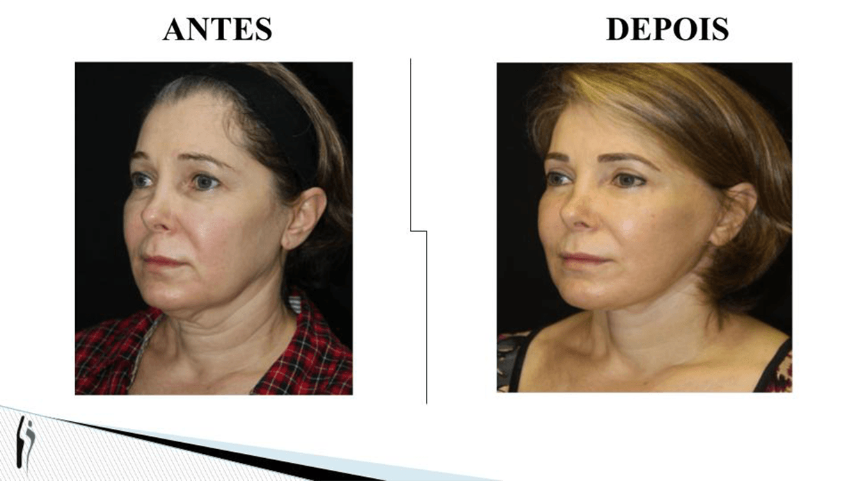 LIFTING FACIAL.pptx (2)