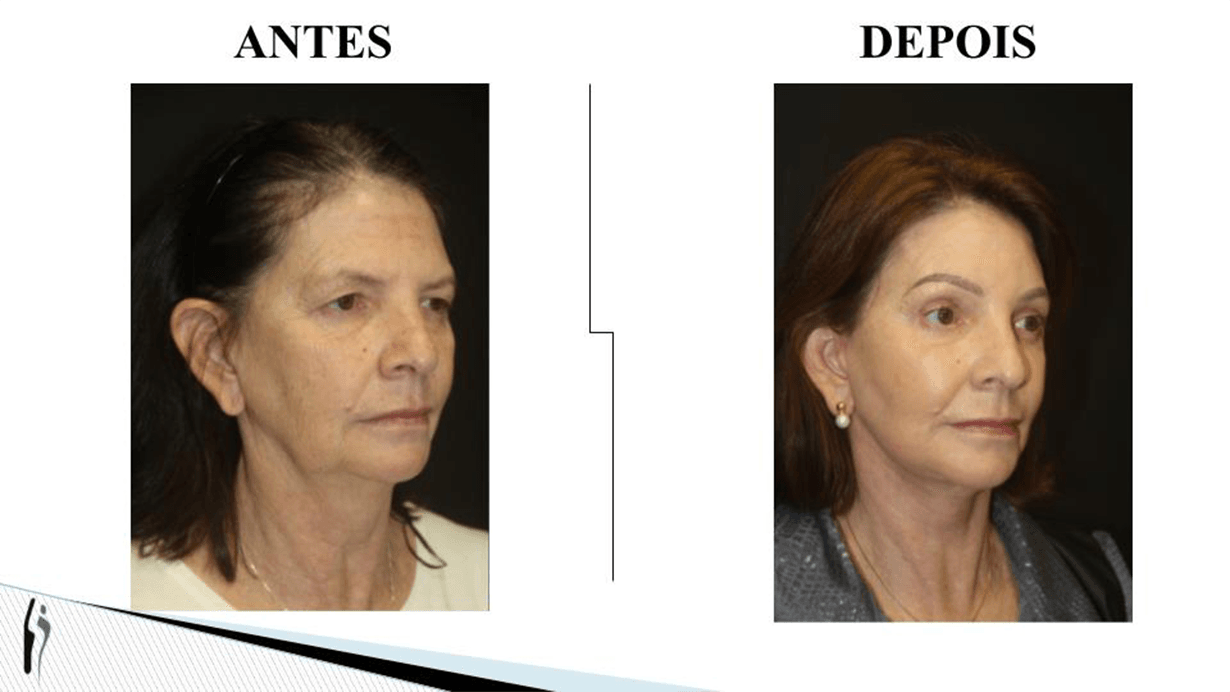 LIFTING FACIAL.pptx (3)