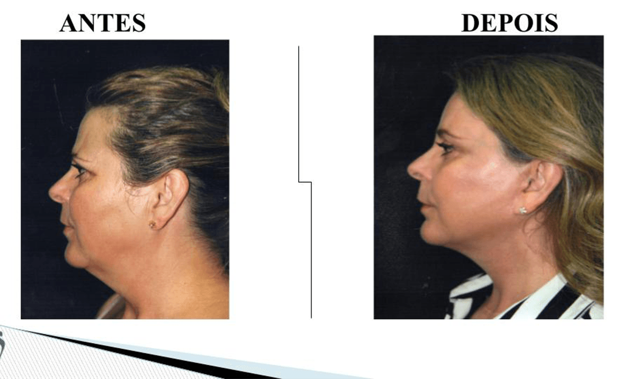 LIFTING FACIAL.pptx (5)